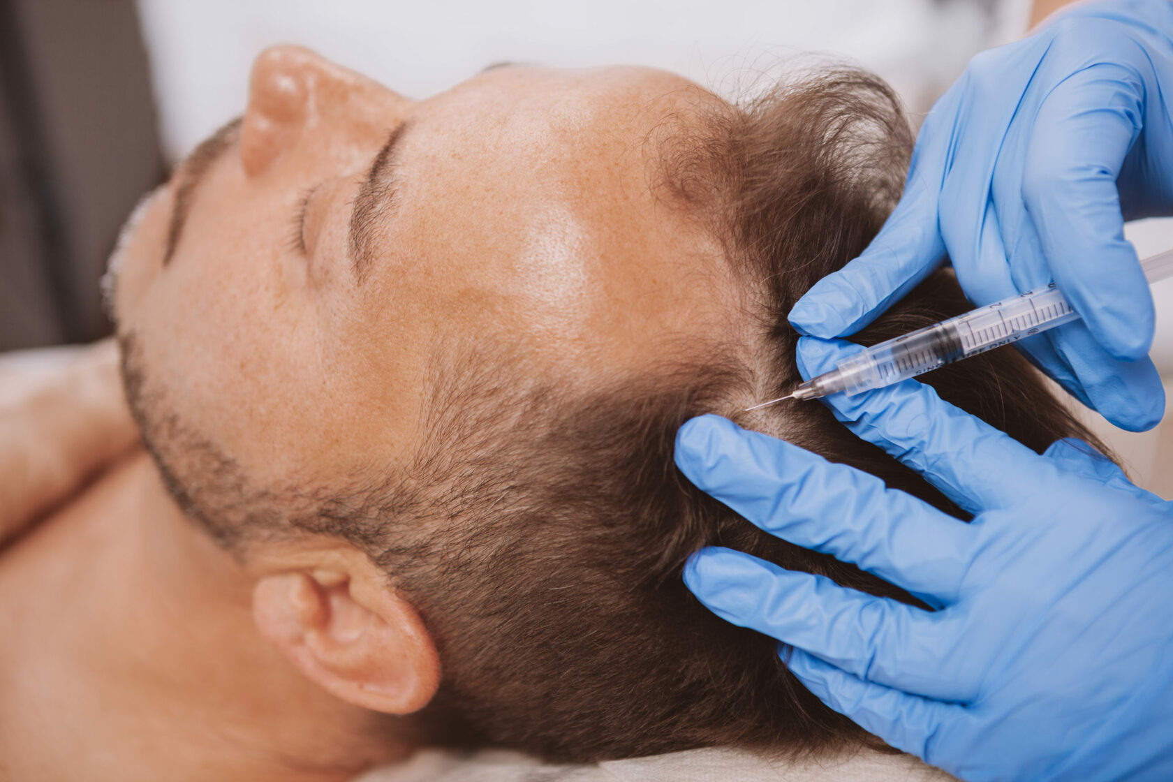 PRP therapy for hair transplant support