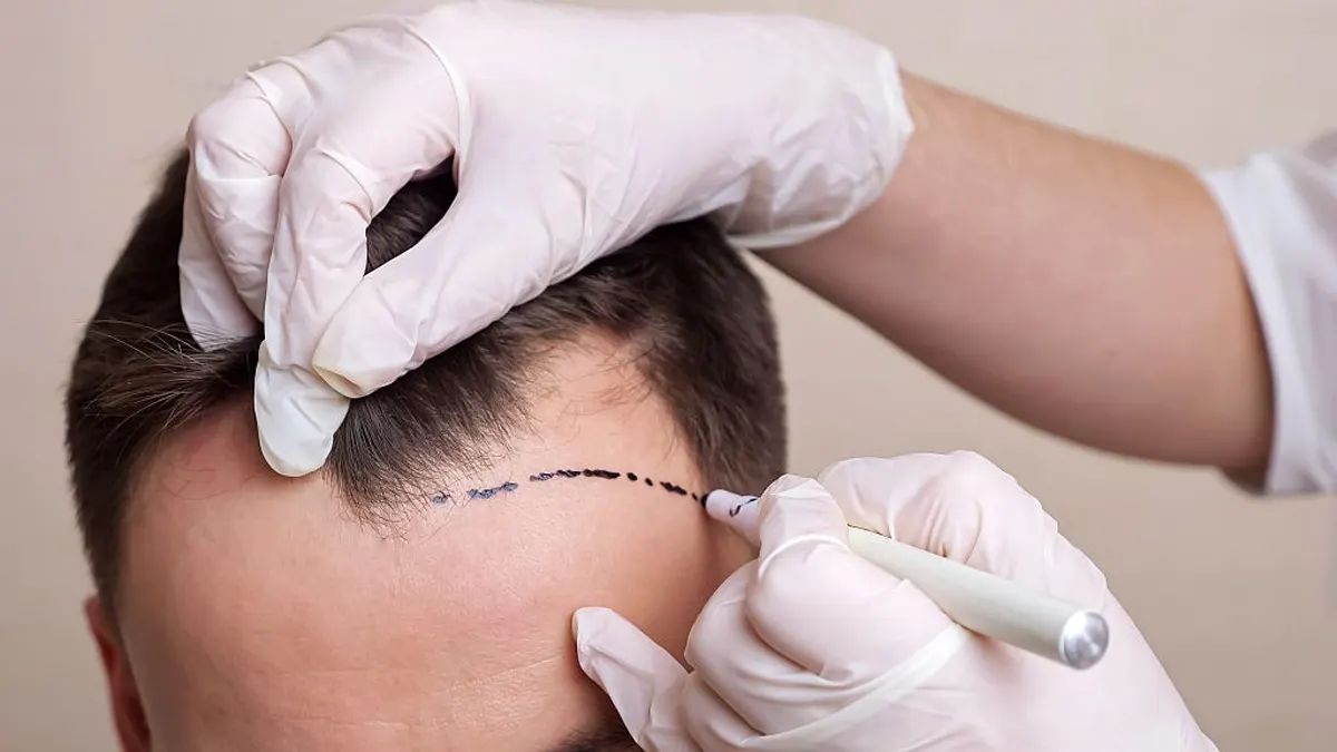 DHI hair transplant at Medixir Clinic