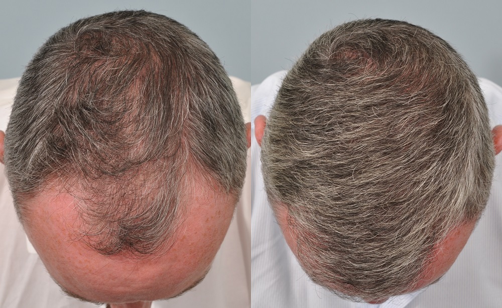 Sapphire FUE hair transplant in Istanbul