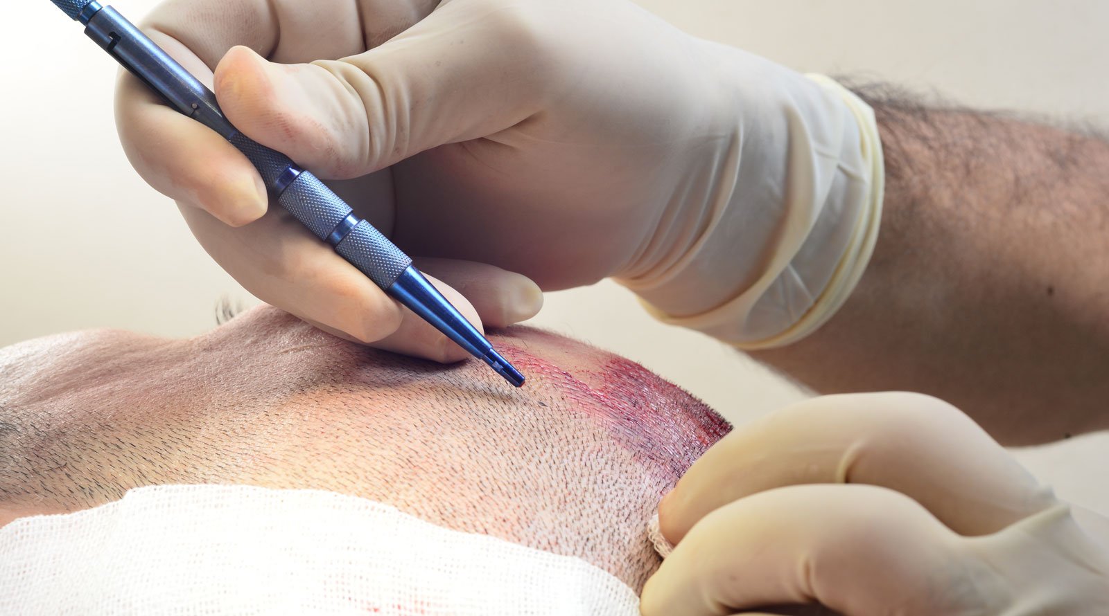 Sapphire FUE — Incision with sapphire tip