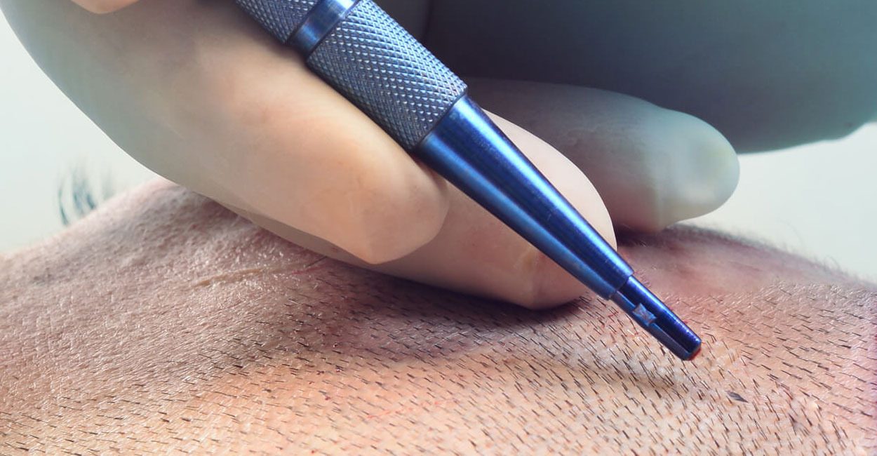 Sapphire FUE — Micro-channel creation